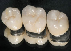 Răng sứ Titan - răng sứ kim loại