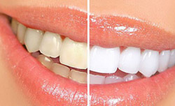 Tẩy trắng răng nhanh và hiệu quả với hệ thống LumaCool – USA