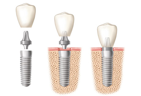 Cấy ghép răng Implant