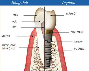 Răng implant và răng thật