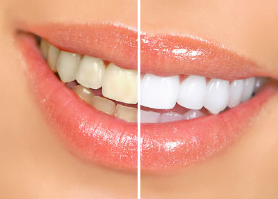 trước và sau khi tẩy trắng răng Các cách tẩy trắng răng